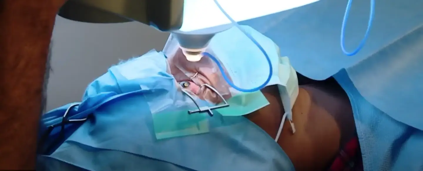 Refractive Surgeries