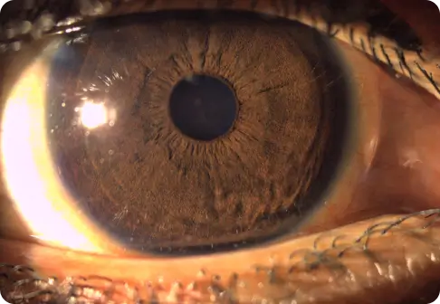 Contact Lenses