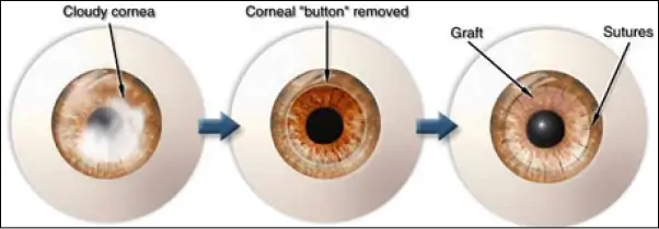 Types of Corneal Grafts