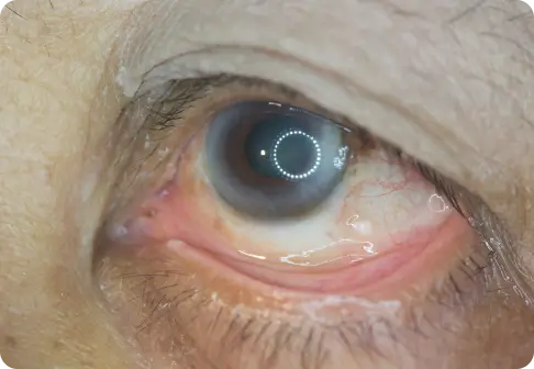 Diabetic Retinopathy