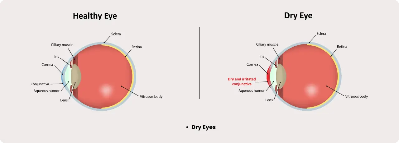 Dry Eyes Treatment