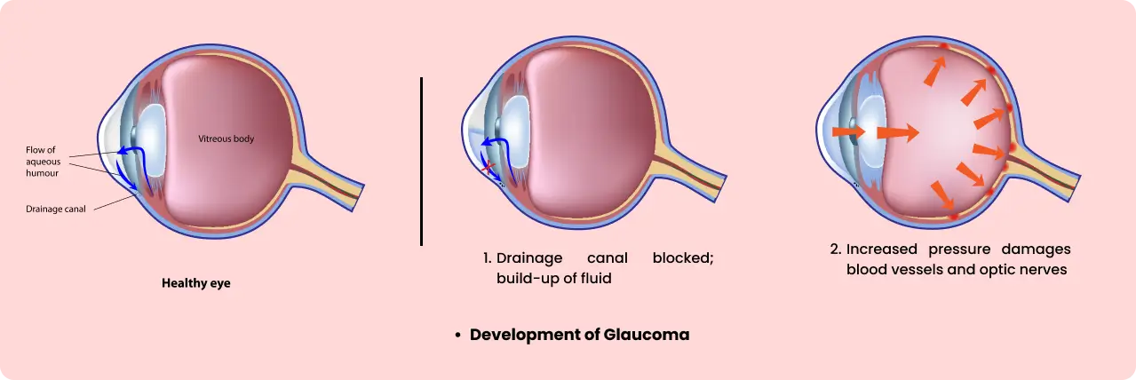 Glaucoma Eye Diagram