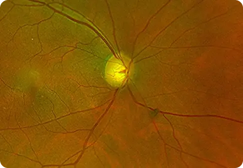 Glaucoma