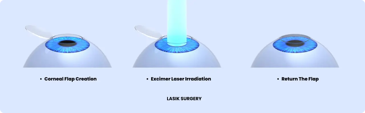 LASIK Eye Diagram