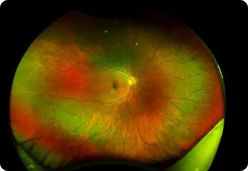 Retina