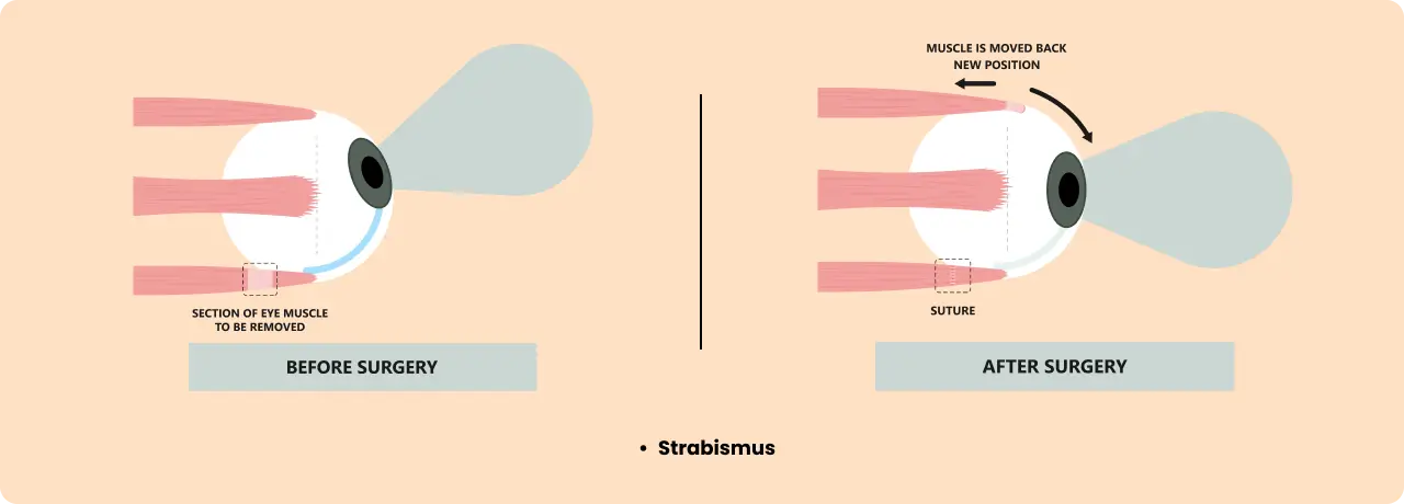 Squint Eye Diagram